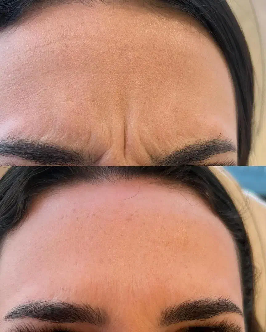 تزریق ژل چربی بوتاکس جوان ساز مزو پی آرپی|خدمات آرایشگری و زیبایی|رشت, گلسار|دیوار