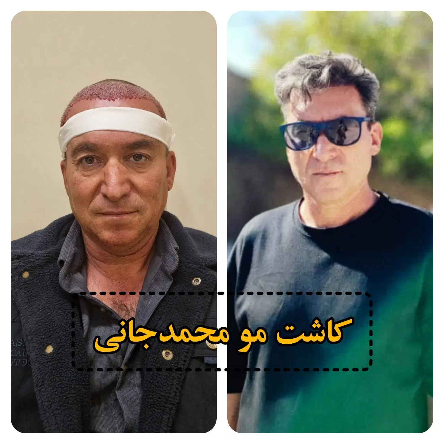 کاشت مو ،ابرو و ریش در شیراز|خدمات آرایشگری و زیبایی|کازرون, |دیوار