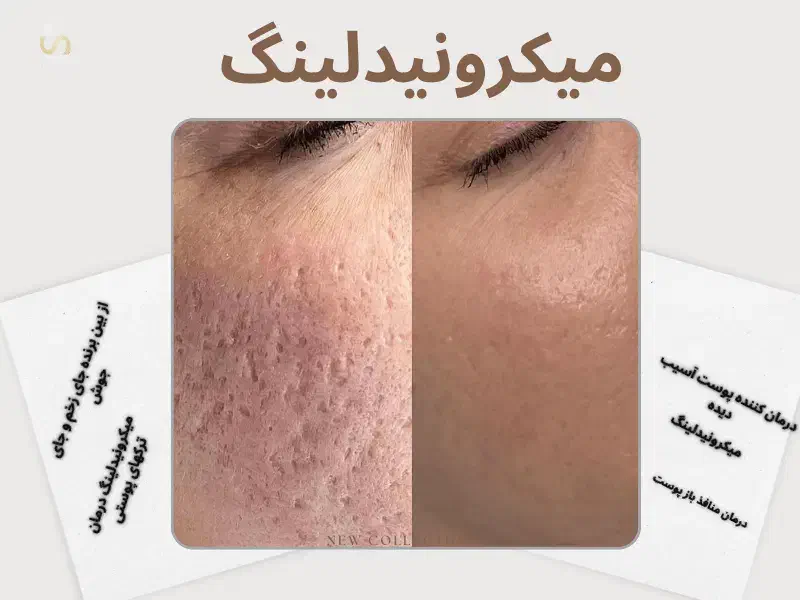 میکرونیدلینگ مزونیدلینگ مزوتراپی در منزل|خدمات آرایشگری و زیبایی|تهران, اختیاریه|دیوار