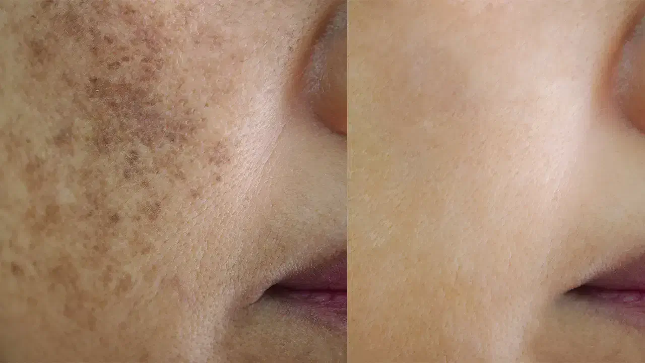 کرم ضدلک و‌جوش و سفید کننده|آرایشی، بهداشتی، درمانی|دهدشت, |دیوار