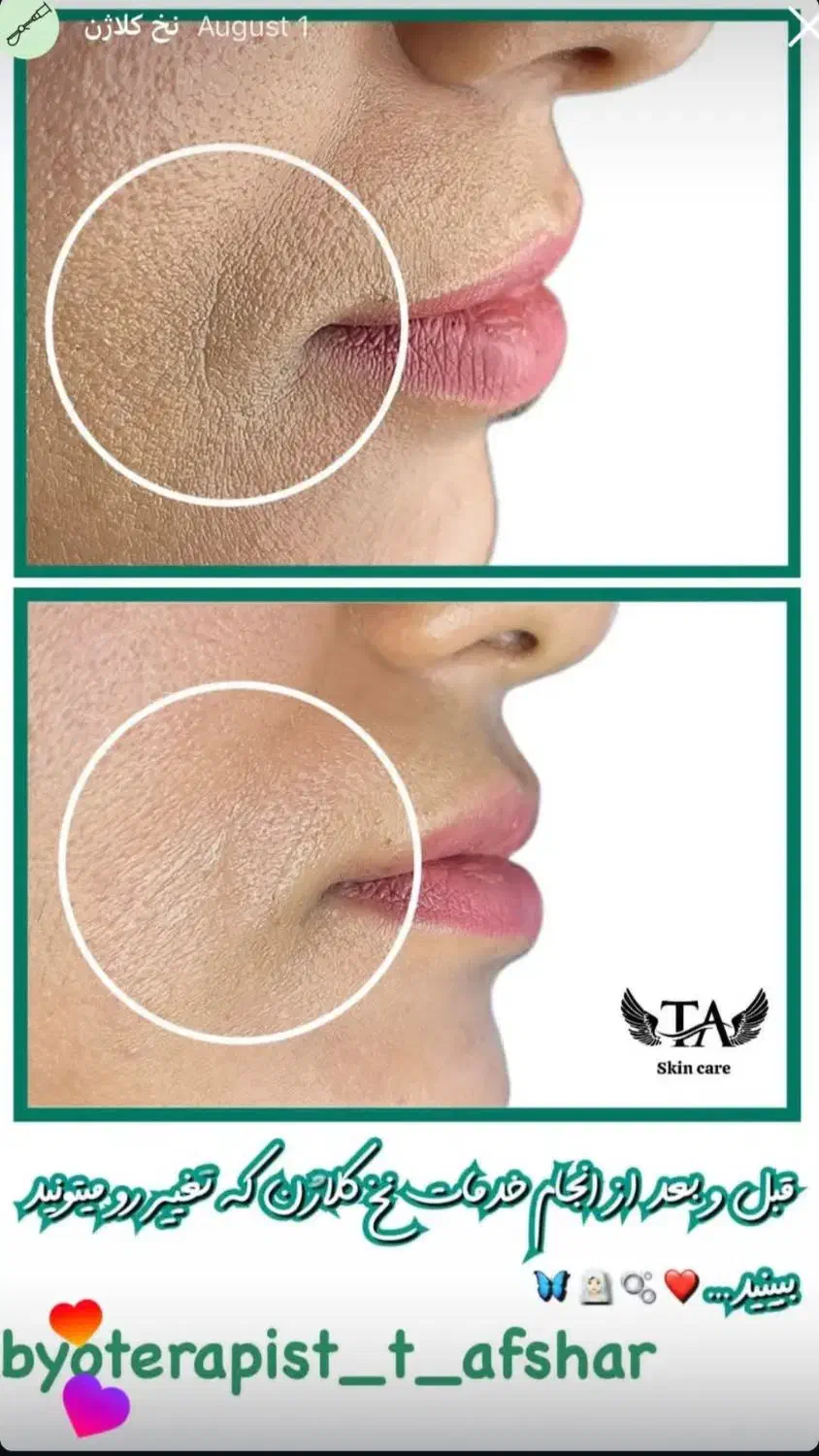 درمان حرفهای لک و ککومک و مزو تراپی|خدمات آرایشگری و زیبایی|برازجان, |دیوار