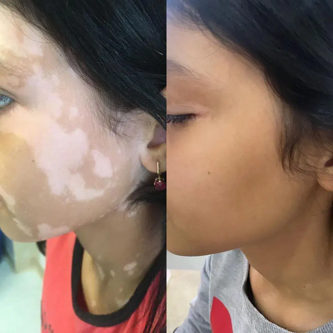 پیسی و پسوریازیس|خدمات آرایشگری و زیبایی|کرمانشاه, |دیوار