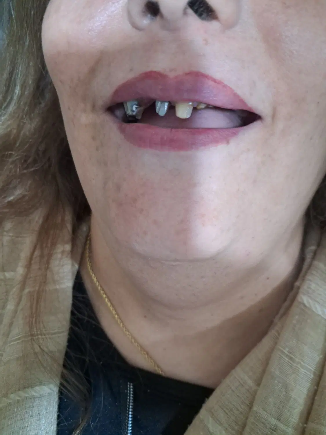 دندانسازی/دندان مصنوعی/ژله ای باشرایط استثنایی|خدمات زیبایی و سلامت|کرج, گوهردشت|دیوار