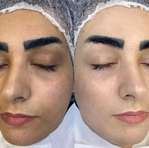 پاکسازی پوست 150|خدمات آرایشگری و زیبایی|سبزوار, قاضی زاد|دیوار