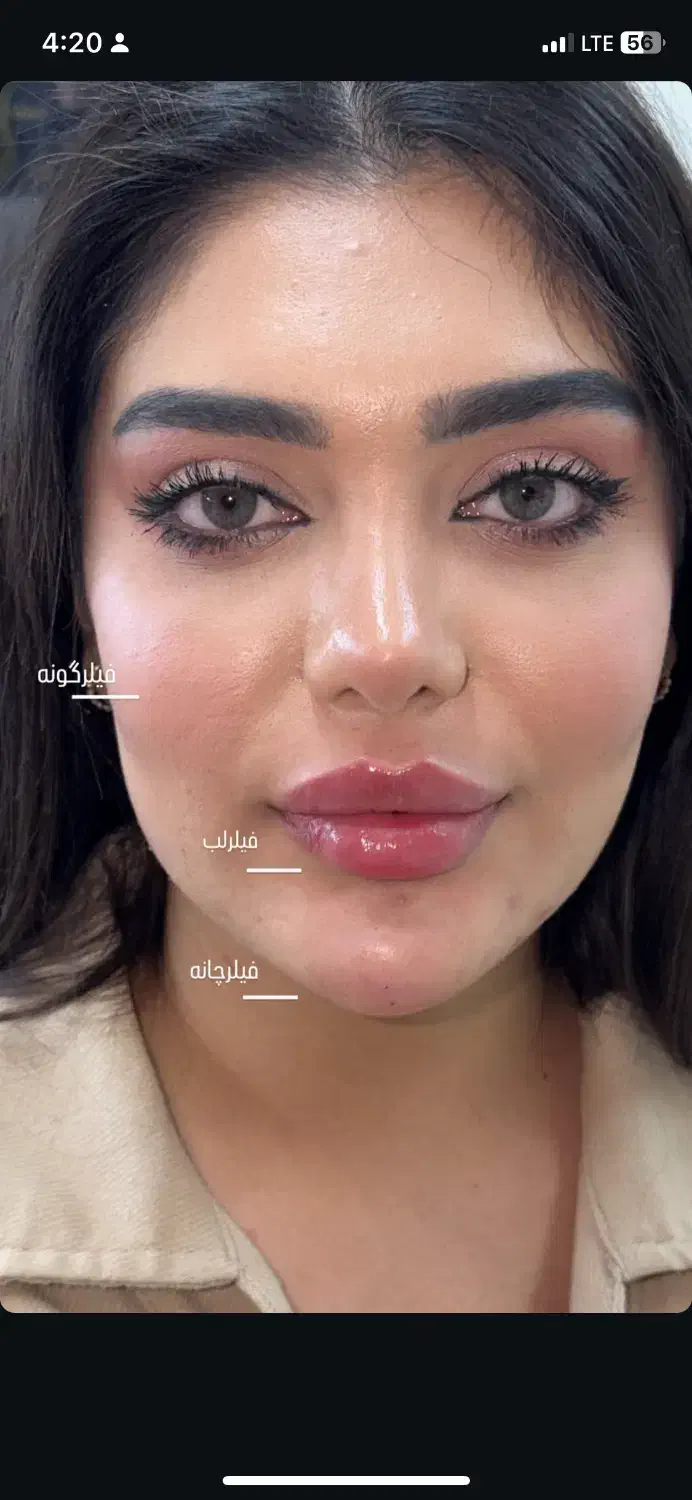 تزریق ژل وجوانسازی تخصصی ومزو ژل،بوتاکس|خدمات آرایشگری و زیبایی|شاهین‌شهر, فردوسی|دیوار