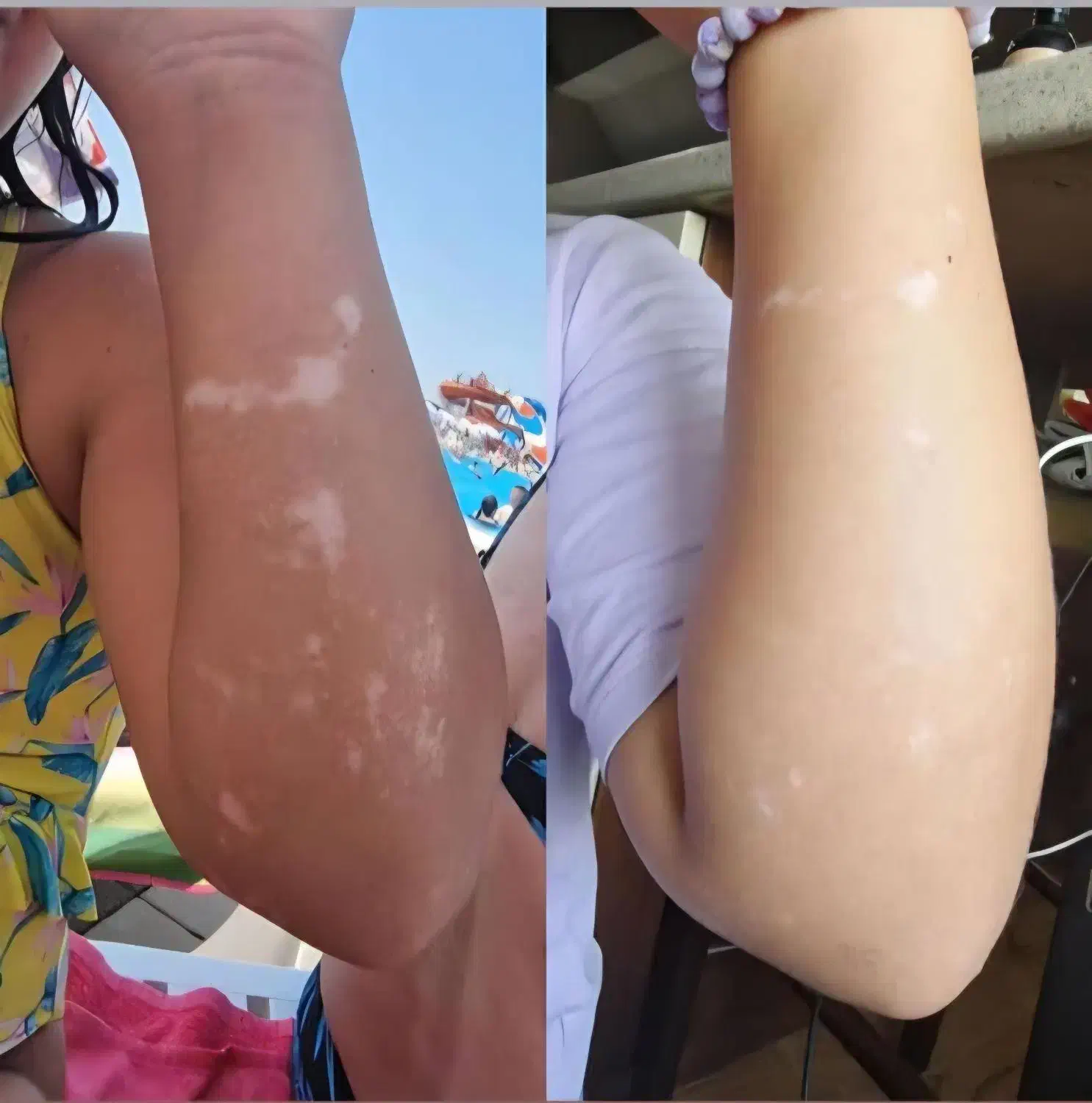 درمان مشکلات پیسی و پسوریازیس|آرایشی، بهداشتی، درمانی|اهواز, غیزانیه|دیوار