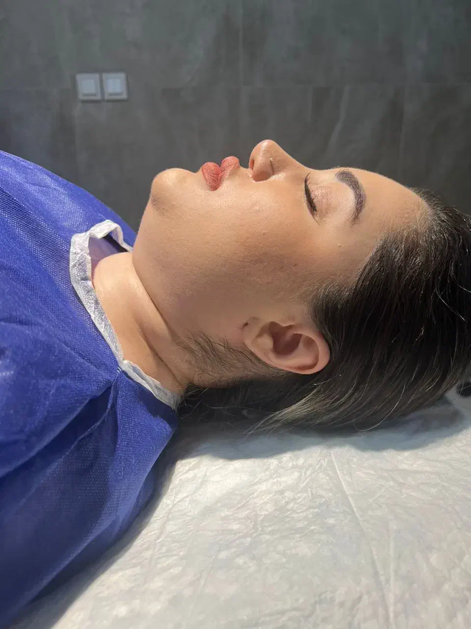 لیپوساکشن غبغب،بوکال فت،فیلرصورت،جوانساز،بوتاکس|خدمات آرایشگری و زیبایی|تهران, شهرک هما|دیوار