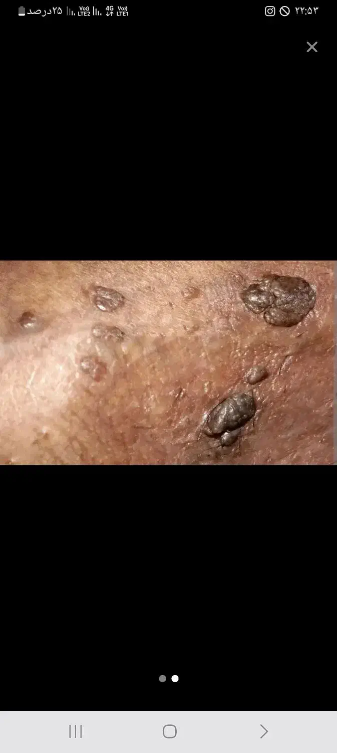 درمان زگیل تناسلی کاملا گیاهی|خدمات آرایشگری و زیبایی|گنبد کاووس, |دیوار