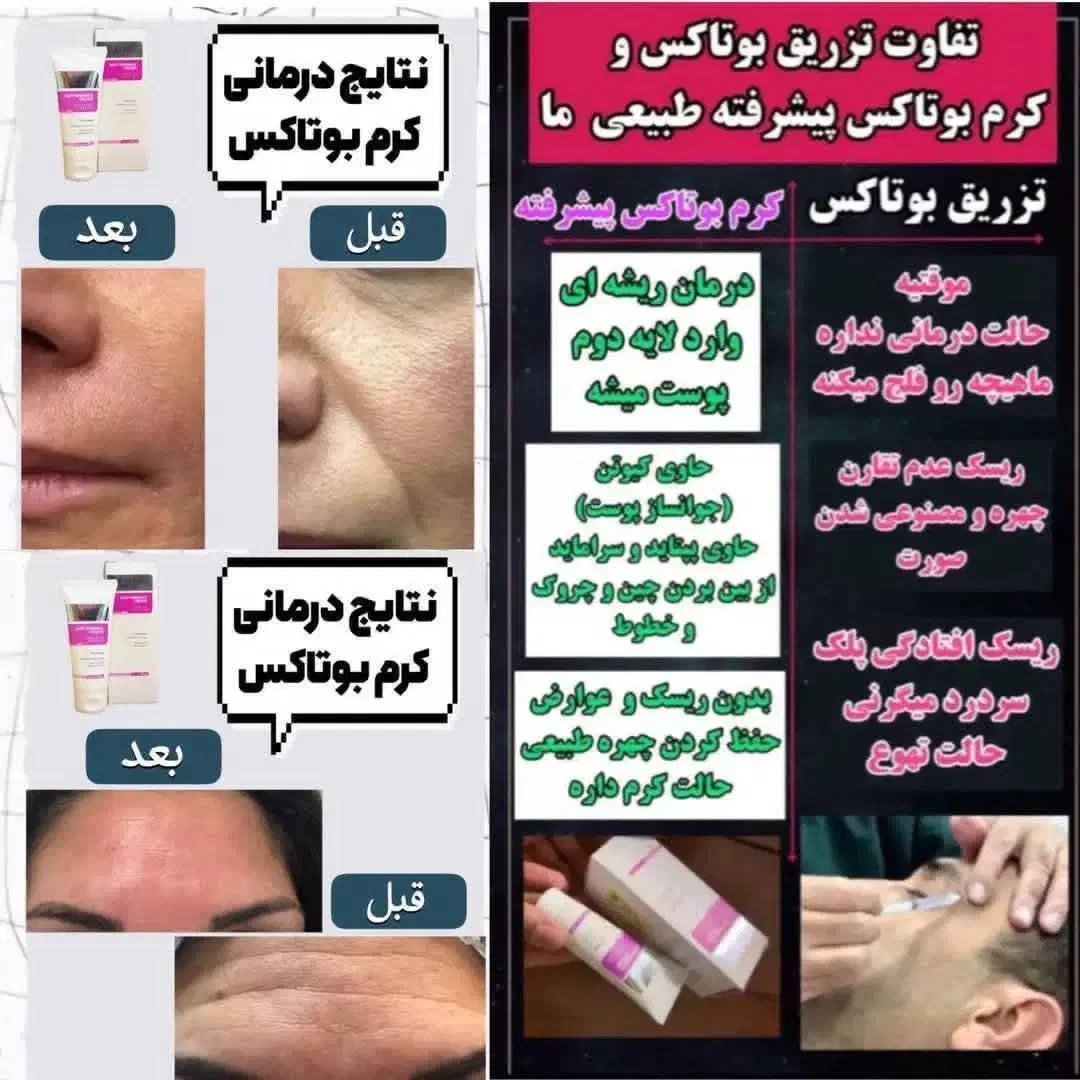 کرم بوتاکس۵ کاره ضد چین و چروک گاتیو اورجینال|آرایشی، بهداشتی، درمانی|تهران, مهران (سیدخندان)|دیوار