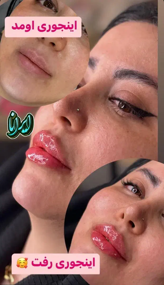 تزریق ژل و بوتاکس تضمینی (کلنیک ایرانا)|خدمات آرایشگری و زیبایی|یاسوج, |دیوار