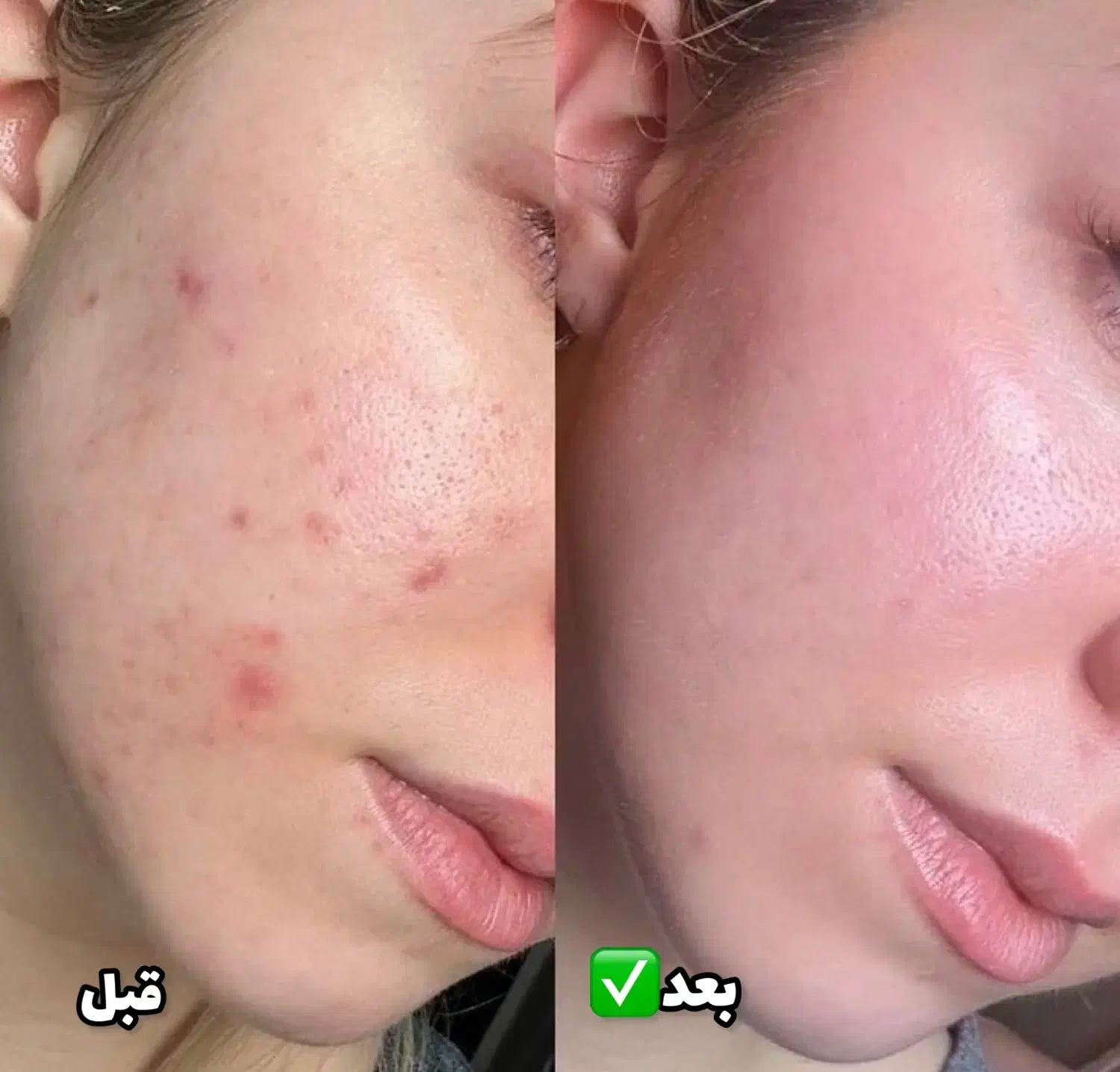 پاکسازی پوست تخفیف یلدا تضمینی|خدمات آرایشگری و زیبایی|ارومیه, |دیوار