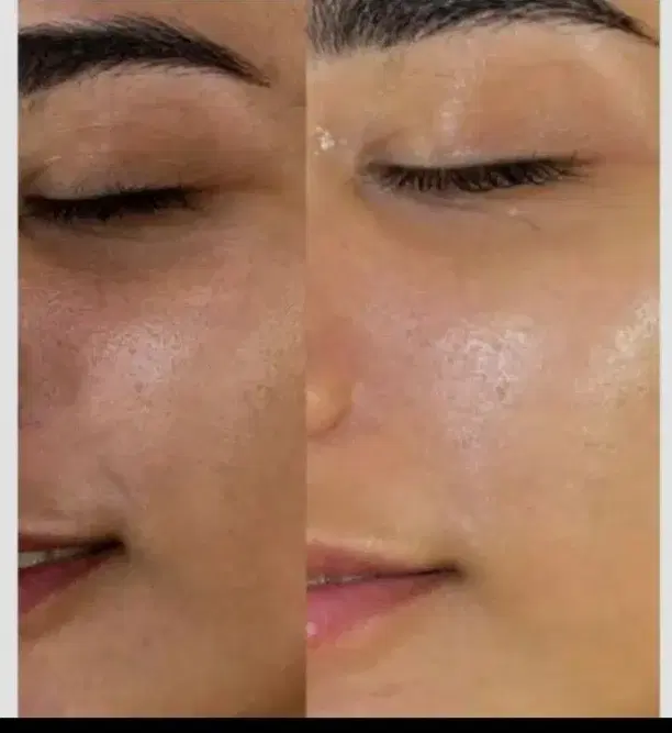 تخفیف 30درصدی فیشیال یک هفته|خدمات زیبایی و سلامت|جیرفت, |دیوار