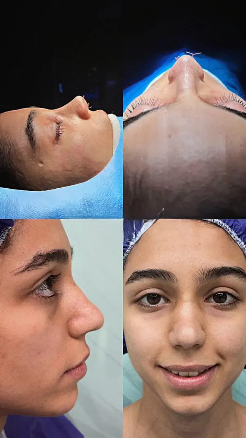 جراحی بینی در تهران با آف ۵۰درصد،جشنواره آذر|خدمات آرایشگری و زیبایی|پاکدشت, پاکدشت (مامازند)|دیوار