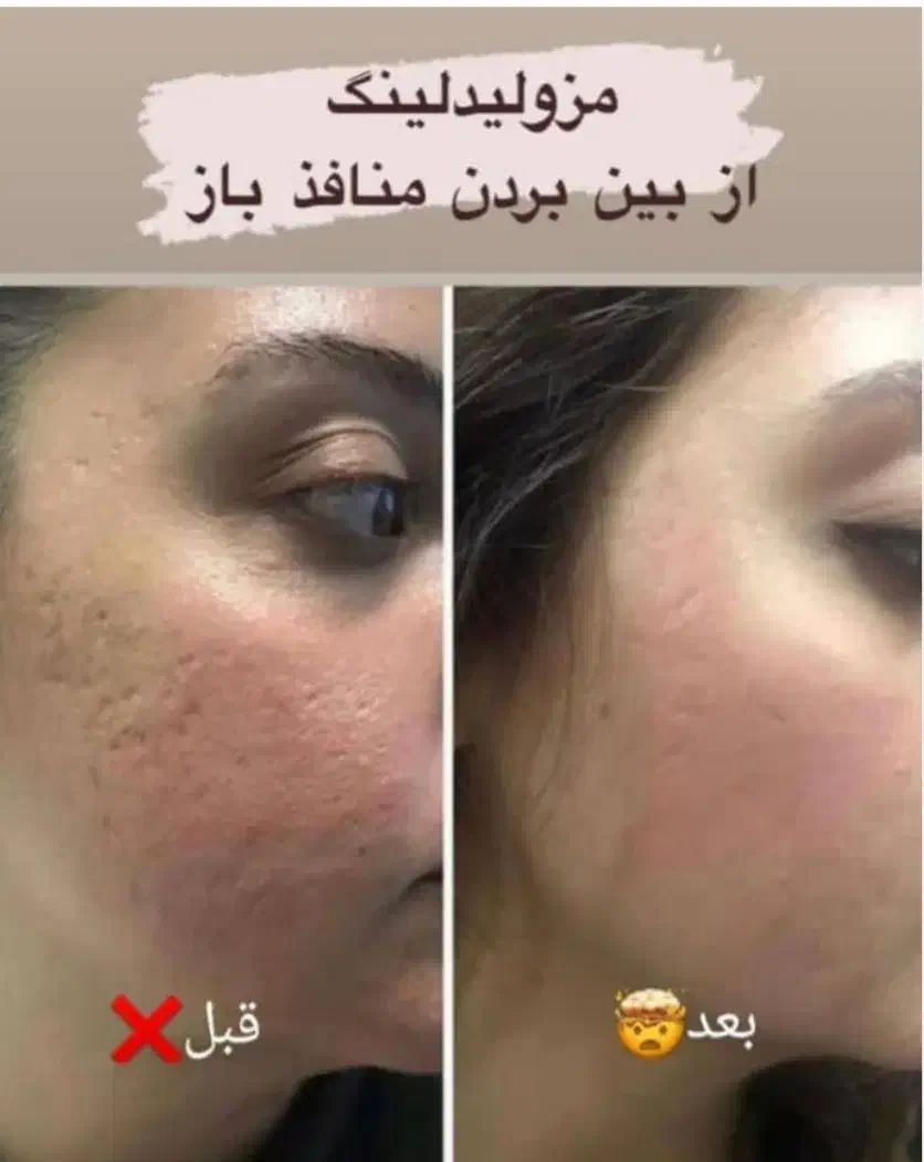 انجام خدمات مزوتراپی و مزوندیلینگ|خدمات آرایشگری و زیبایی|بوشهر, |دیوار