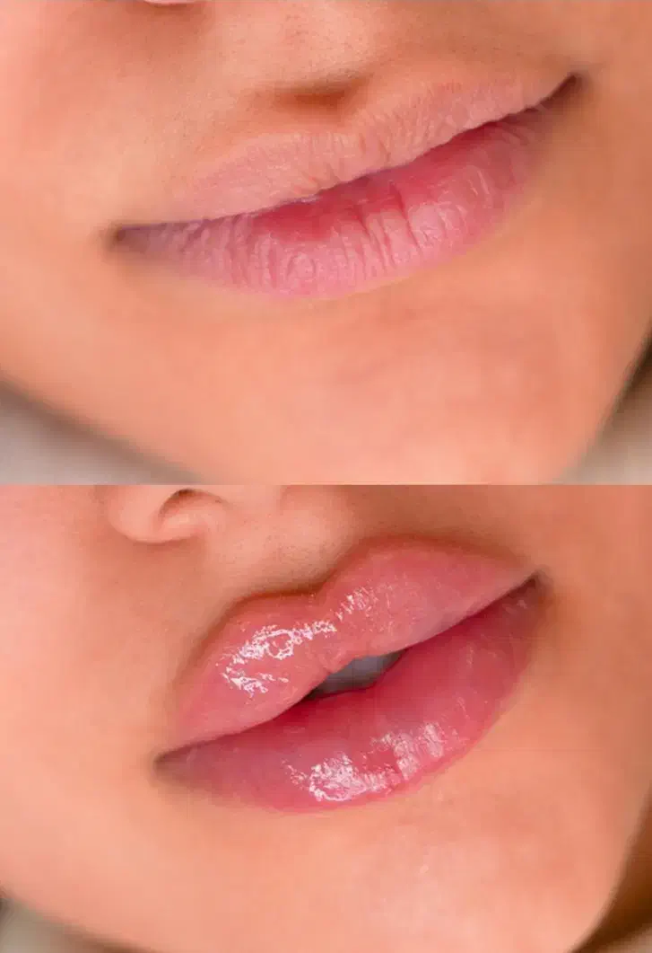 تخفیف ژل و بوتاکس ویژه فقط برای فردا|خدمات آرایشگری و زیبایی|مشهد, شهید معقول|دیوار