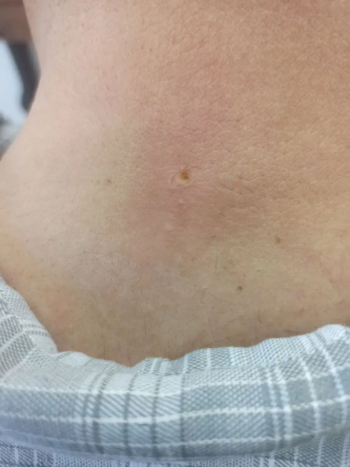 برداشت خال بالیزر بدون خون ریزی در یک جلسه|خدمات آرایشگری و زیبایی|ایلام, |دیوار