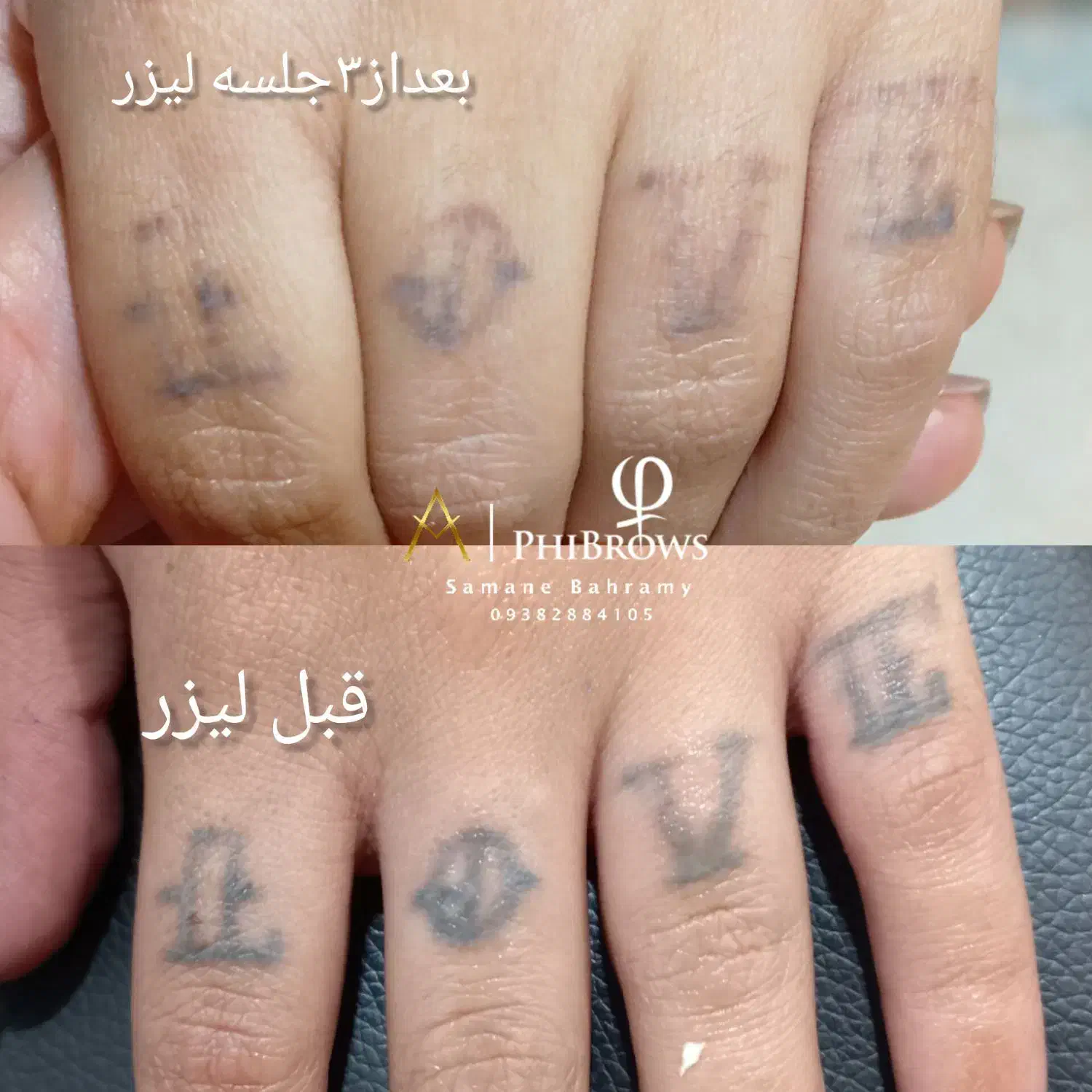 پاک کردن تاتوبالیزرکیوسوییچ|خدمات آرایشگری و زیبایی|مشهد, گلشور|دیوار