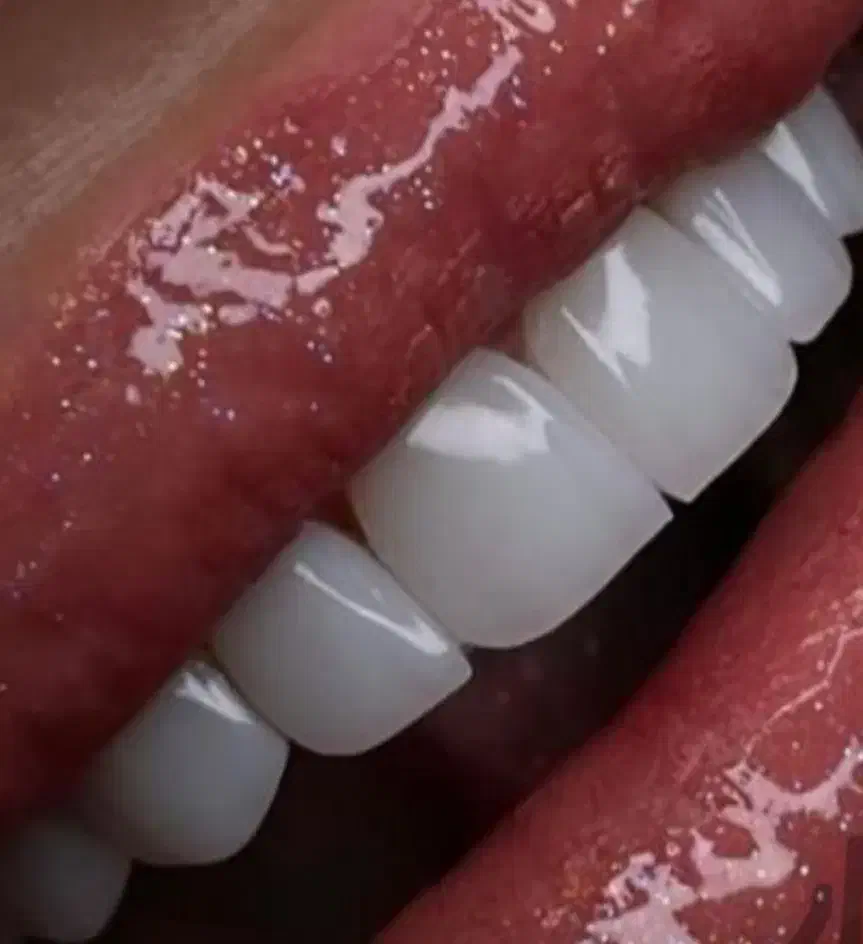 کامپوزیت دندان|خدمات آرایشگری و زیبایی|آبادان, |دیوار