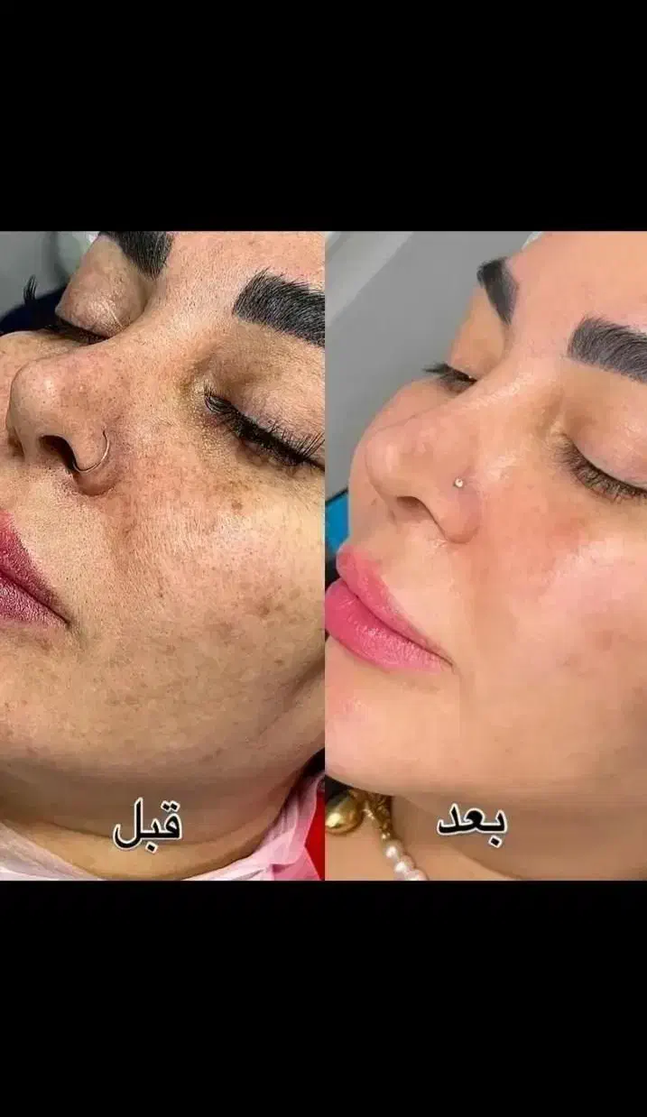 ژل گیاهی جوانسازی ضدلک ضدجوش ضدکک مک|آرایشی، بهداشتی، درمانی|بروجرد, |دیوار