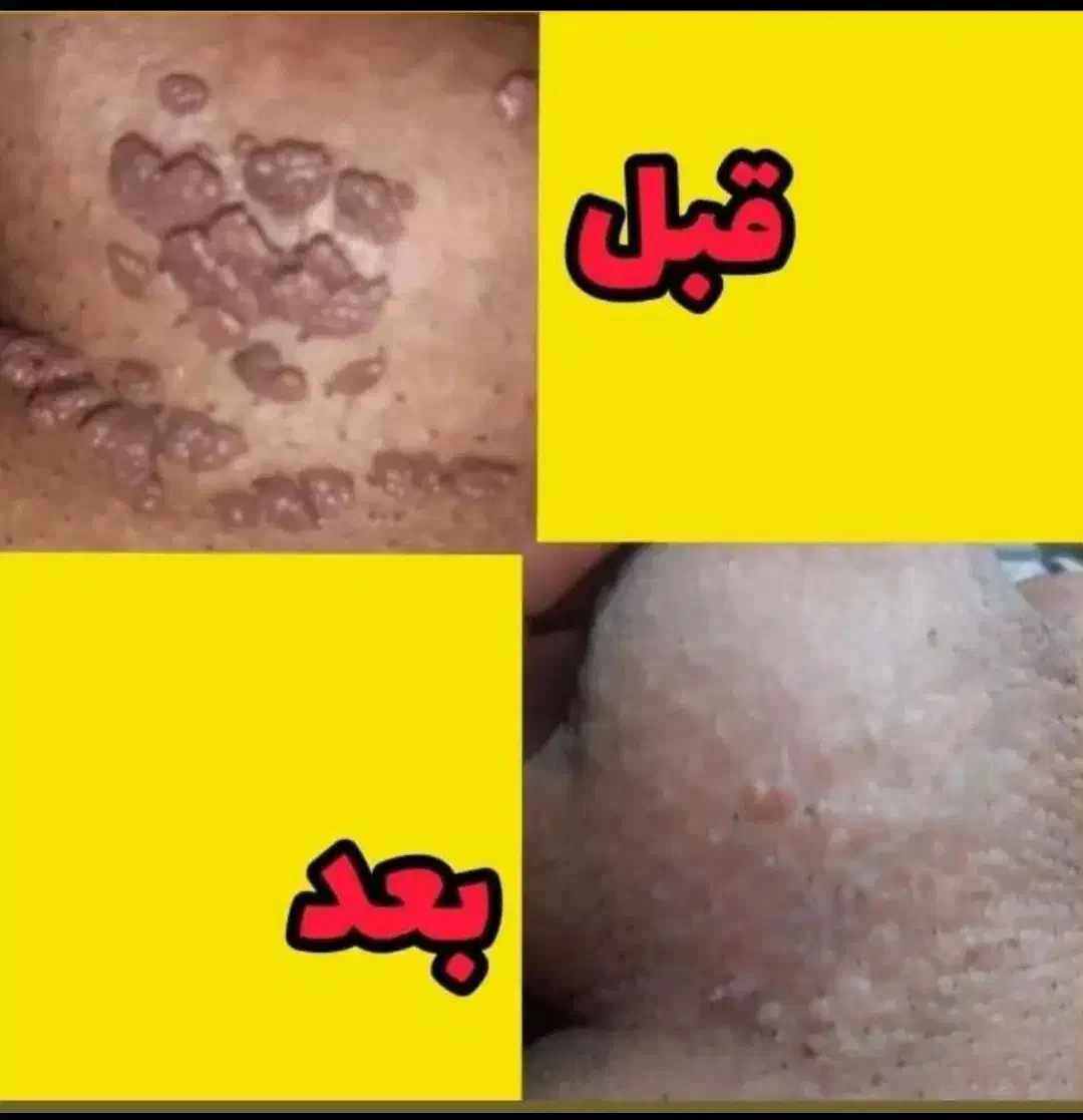 درمان ریشه ای زگیل و تبخال به صورت گیاهی|آرایشی، بهداشتی، درمانی|ساری, |دیوار