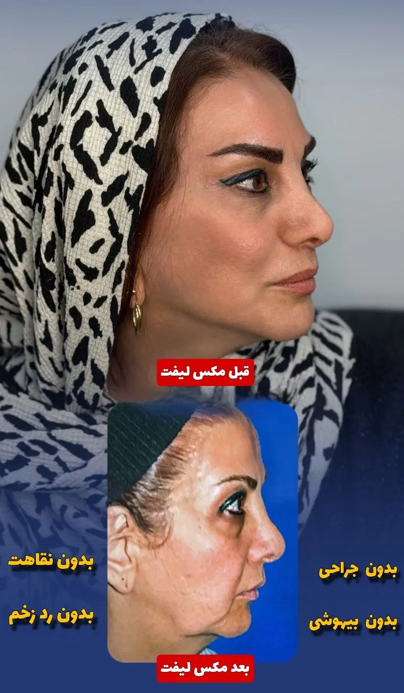جشنواره جوانسازیMax Lift پزشک پوست مو ژل بینی ابرو|خدمات زیبایی و سلامت|مشهد, هفت تیر (حافظ)|دیوار