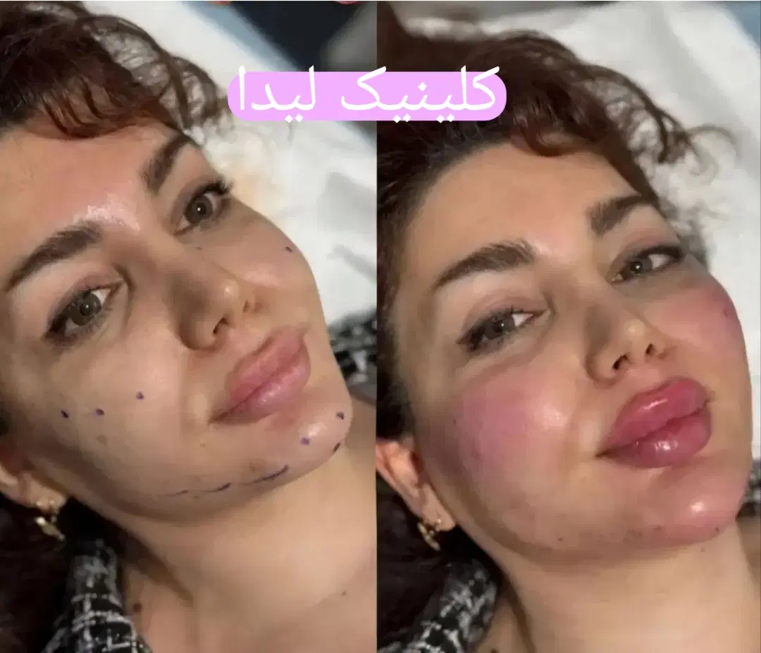جشنواره ژل لب فیلرمزو1050بوتاکس950 پزشک متخصص|خدمات زیبایی و سلامت|مشهد, سجاد شهر|دیوار