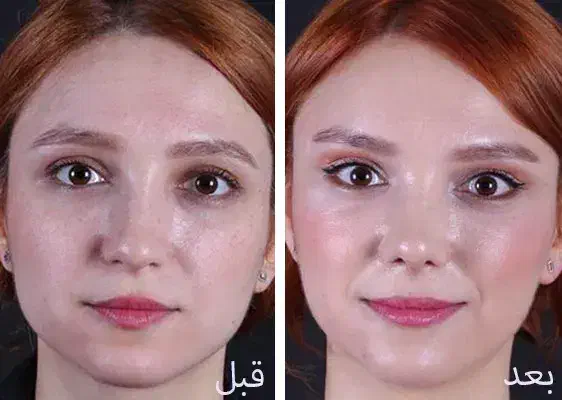بوتاکس با تعرفه ی دولتی|خدمات آرایشگری و زیبایی|تهران, وصفنارد|دیوار