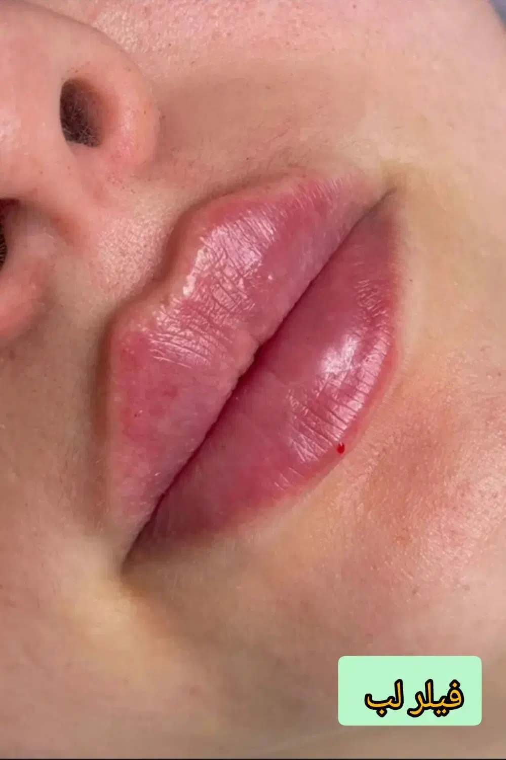 خدمات تخصصی فیلر و بوتاکس ومزوتراپی|خدمات آرایشگری و زیبایی|شاهینشهر, فردوسی|دیوار