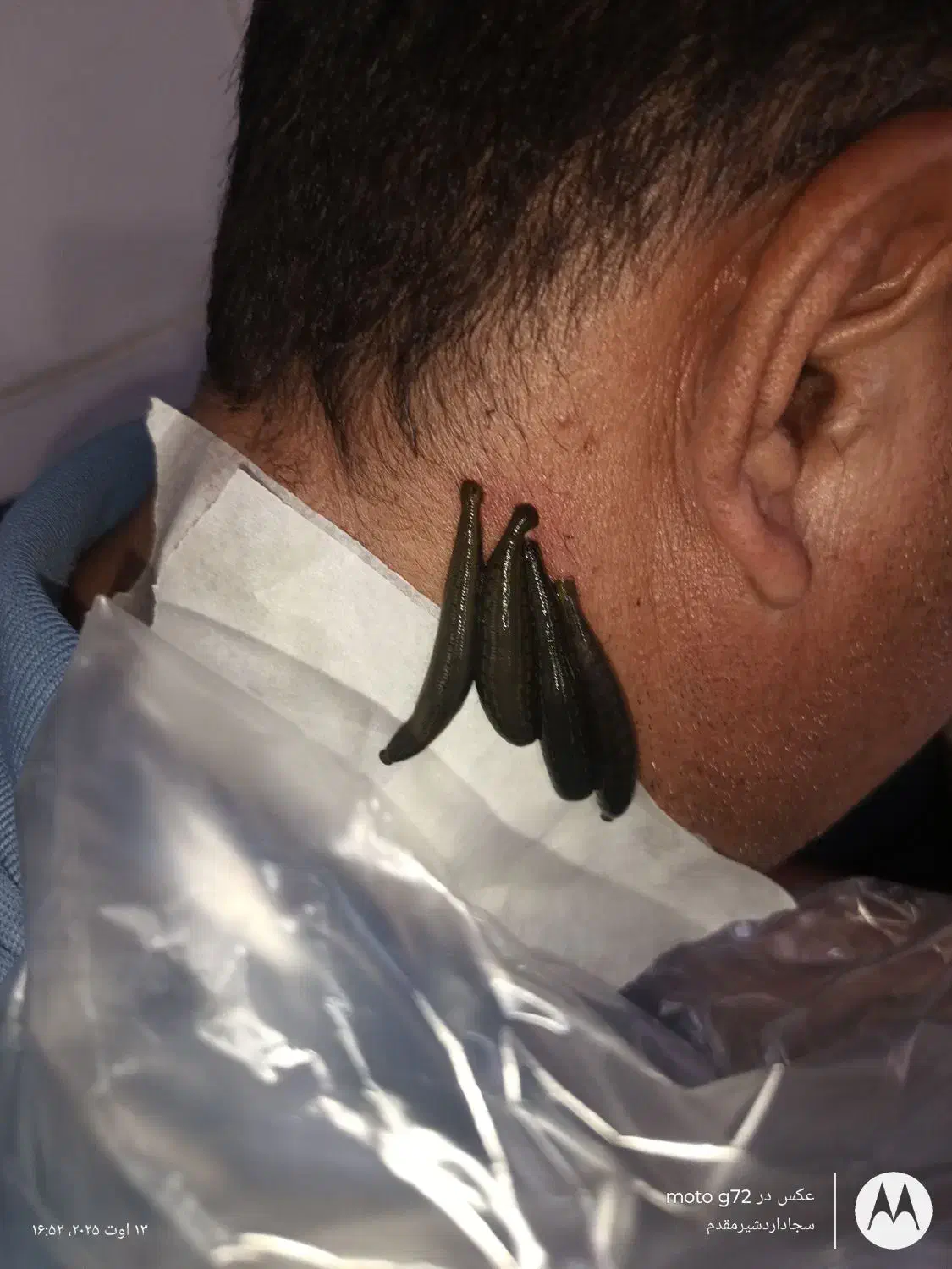 حجامت زالو فصد|آرایشی، بهداشتی، درمانی|یاسوج, |دیوار