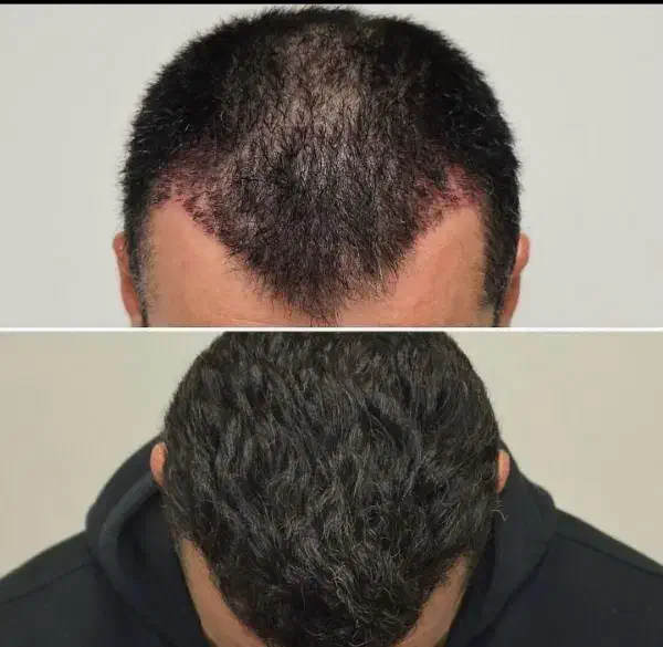 جشنواره لیفت فیلربوتاکس بلفارو نخ تزریق چربی فشیال|خدمات آرایشگری و زیبایی|اصفهان, ملکشهر|دیوار