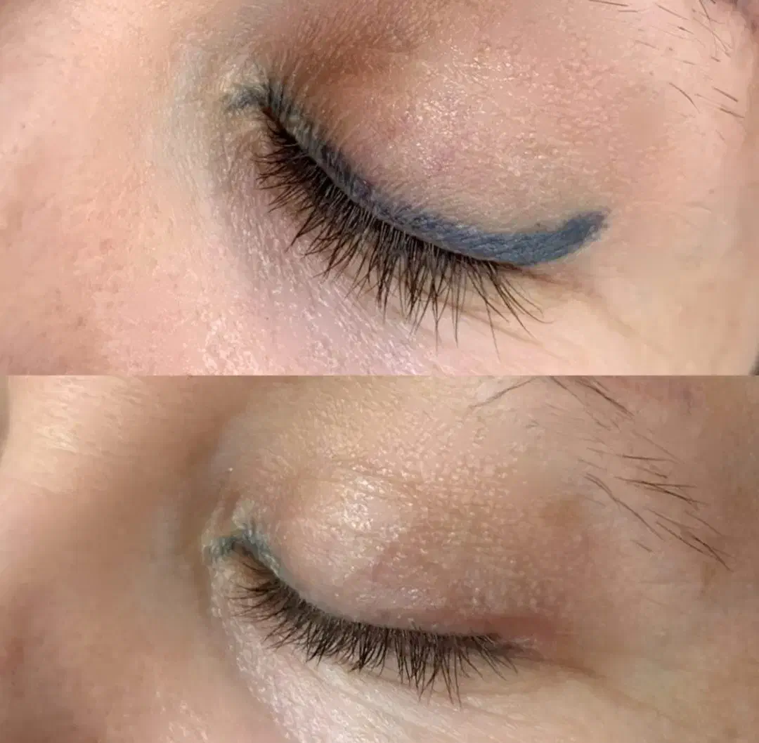 مدل فوری ریموو تتوی قدیمی وبدرنگ|خدمات آرایشگری و زیبایی|آمل, |دیوار