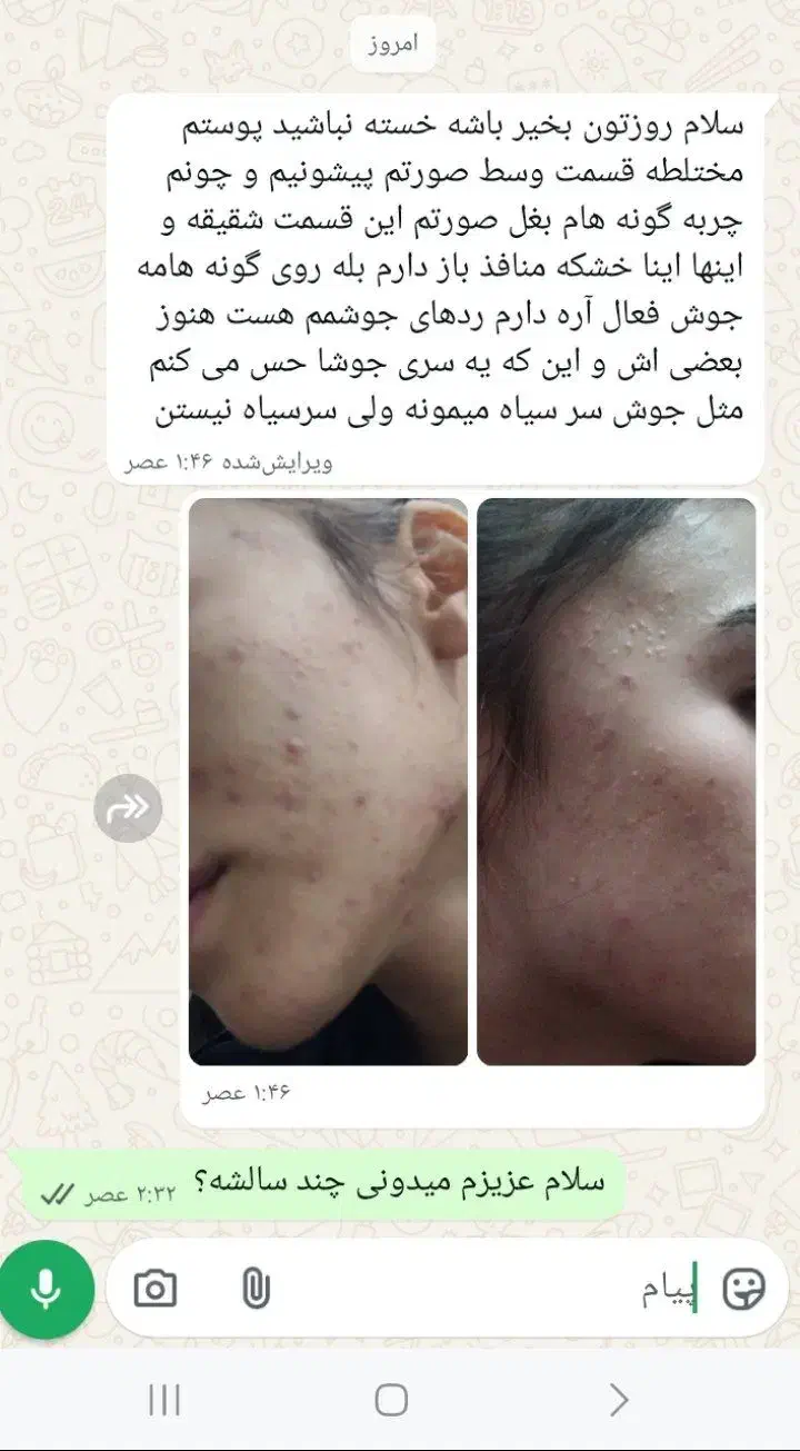 سرم گیاهی ضدجوش و لک|آرایشی، بهداشتی، درمانی|سلماس, |دیوار