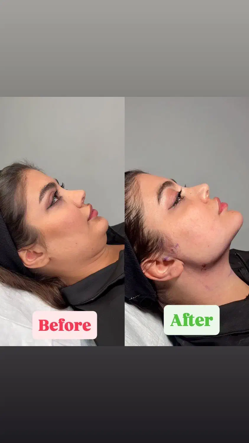 تخلیه چربی غبغب|خدمات آرایشگری و زیبایی|تهران, ایوانک|دیوار