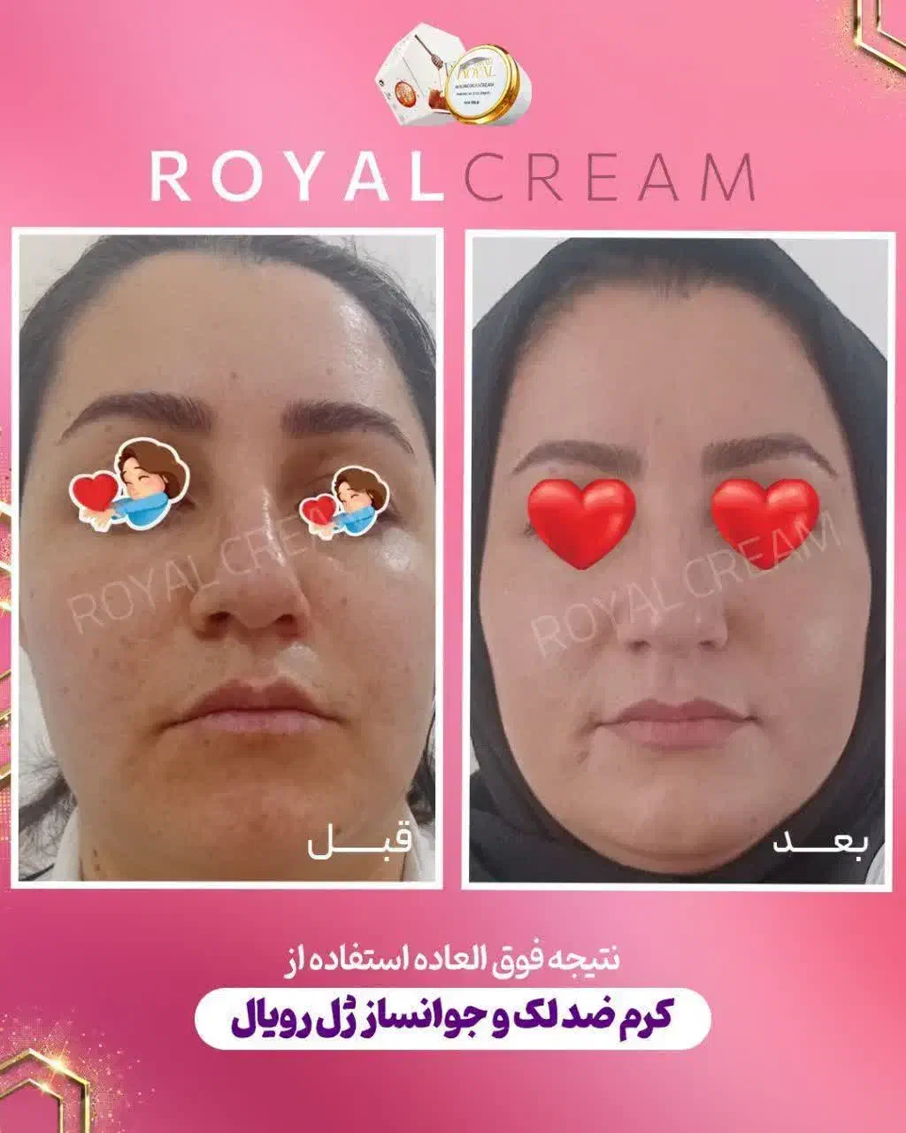 کرم ژل رویال بهترین ضدلک|آرایشی، بهداشتی، درمانی|قم, امامزاده ابراهیم|دیوار