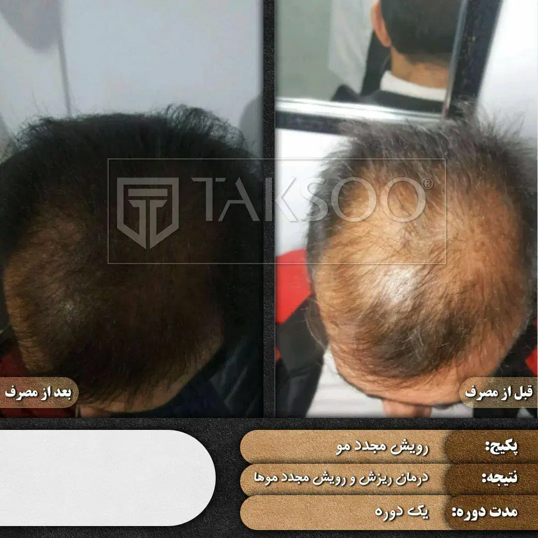 درمان ریزش مو ورویش مجدد|آرایشی، بهداشتی، درمانی|اردل, |دیوار