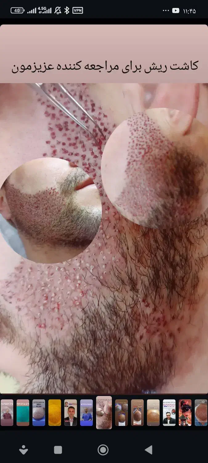 کاشت مووابروبه بدون جراحی ودردوبصورت اقساطی|خدمات آرایشگری و زیبایی|تبریز, |دیوار