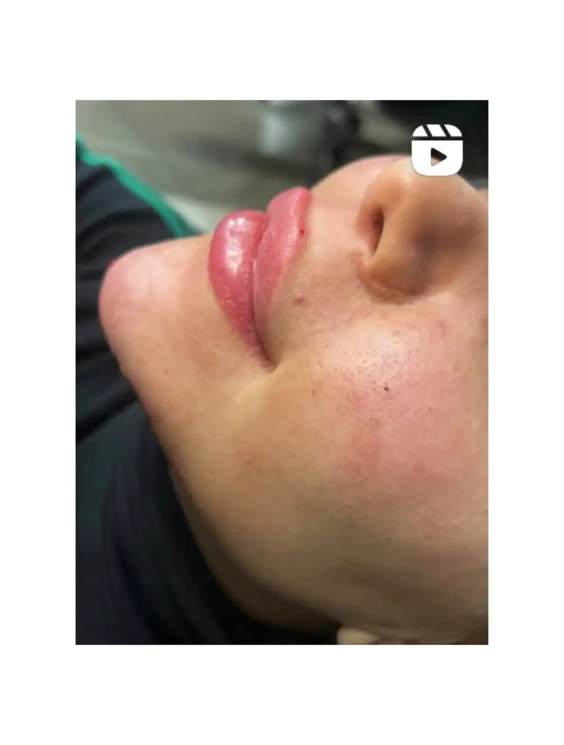 فیلر‌‌ صورت /  ژل صورت|خدمات آرایشگری و زیبایی|فولادشهر, B2|دیوار