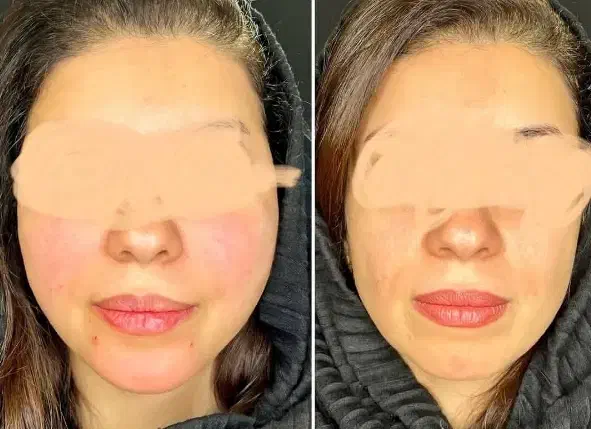ژل،بوتاکس،مزو،چال لپ،فیلر|خدمات آرایشگری و زیبایی|قم, عمار یاسر|دیوار