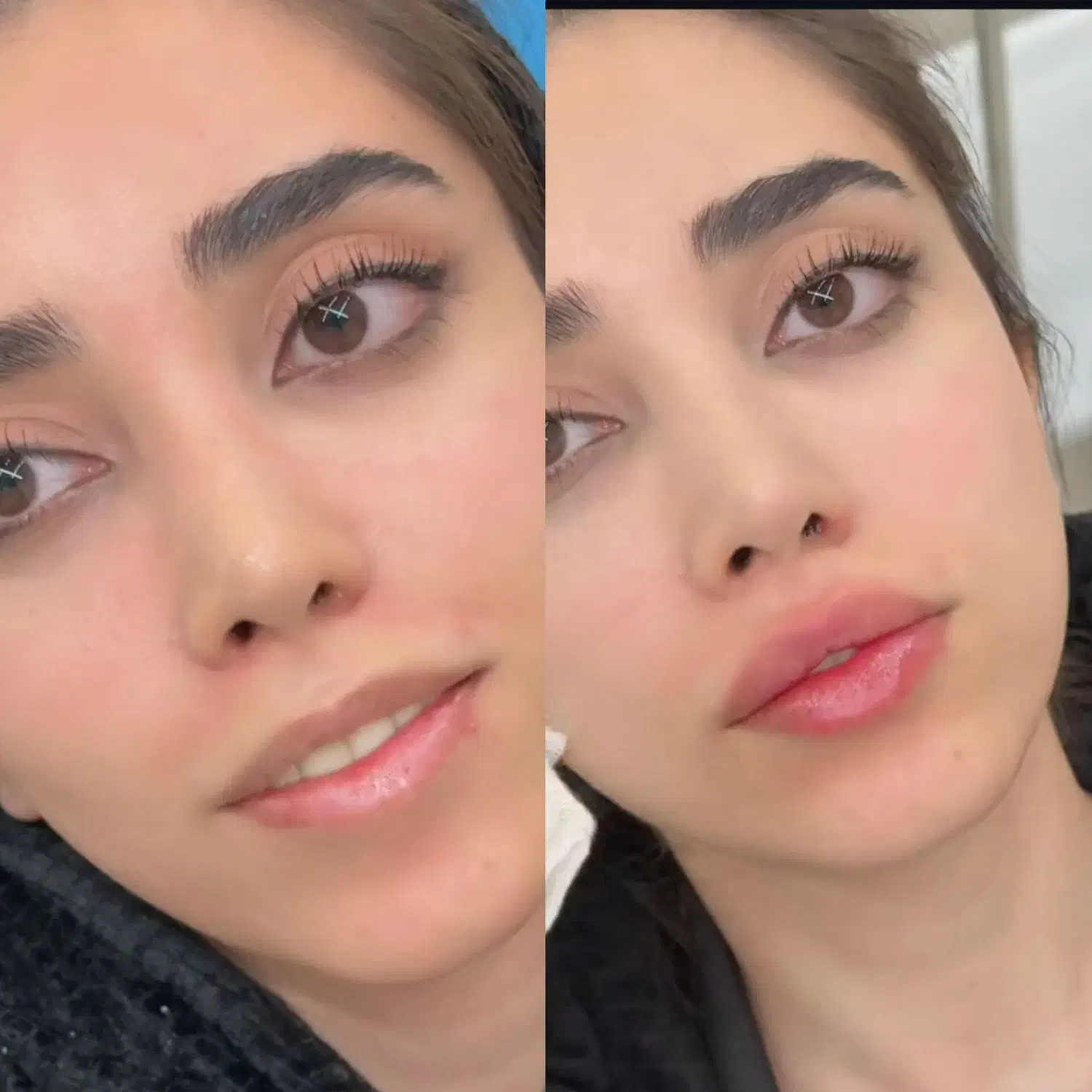 تزریق فیلر، بوتاکس، مادلینگ زیر نظر متخصص|خدمات آرایشگری و زیبایی|کرمانشاه, |دیوار