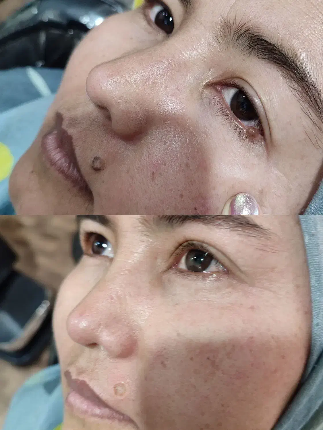 خدمات لیزر خال و منگوله های گوشتی،همورییدوزیگیل|خدمات زیبایی و سلامت|تهران, مسعودیه|دیوار