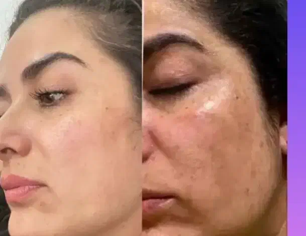 درمان لک درخانه|آرایشی، بهداشتی، درمانی|زرند, |دیوار