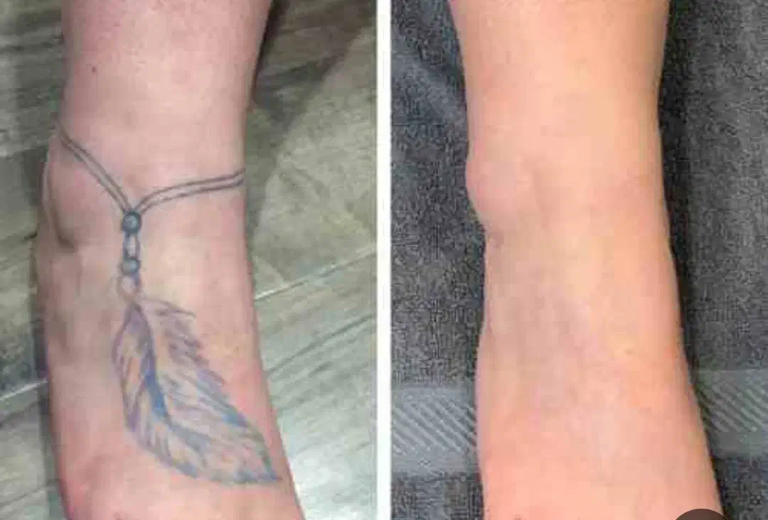 حذف تتو های بد رنگ و قدیمی|خدمات آرایشگری و زیبایی|کاشان, کشاورز|دیوار