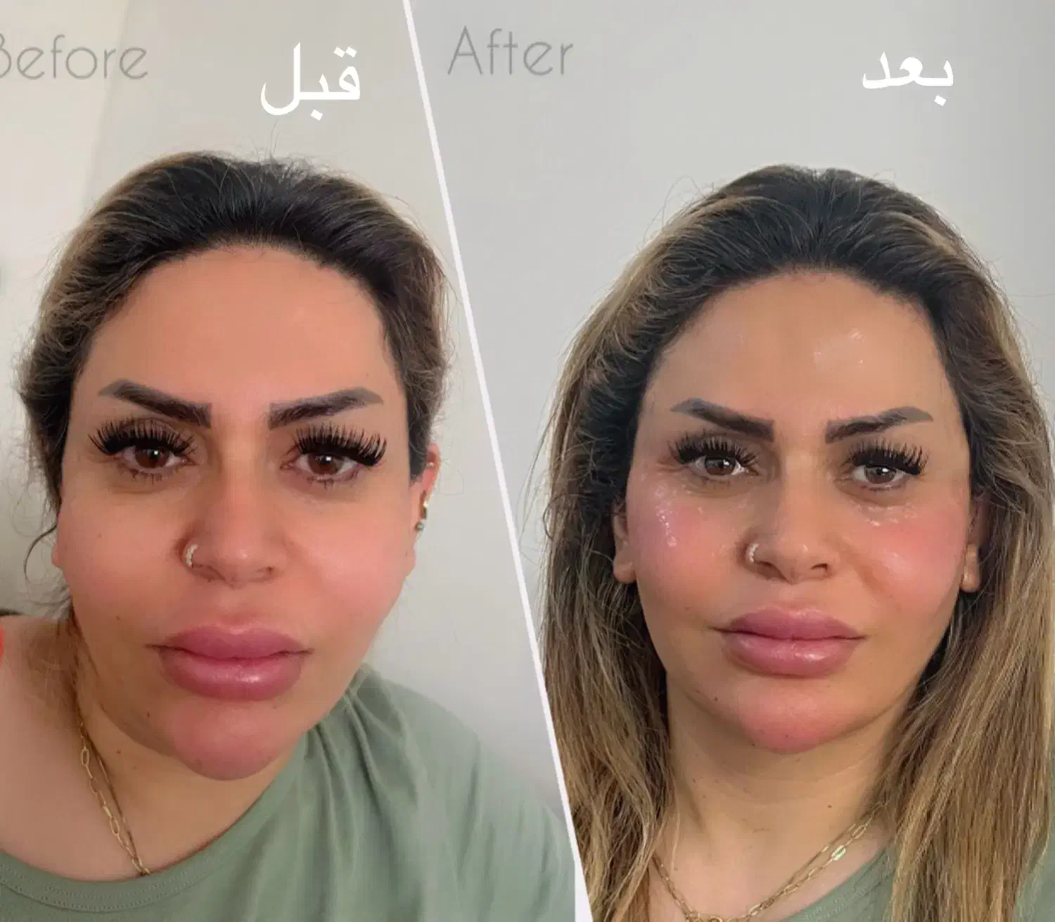 ژل بوتاکس کانتورینگ صورت آنزیم فیلر بینی مزوژل|خدمات آرایشگری و زیبایی|گرمسار, |دیوار