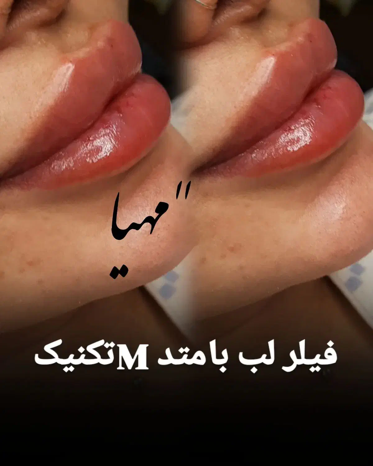 فیلر و بوتاکس وانزیم فیلر|خدمات آرایشگری و زیبایی|قم, دروازه چوبی|دیوار