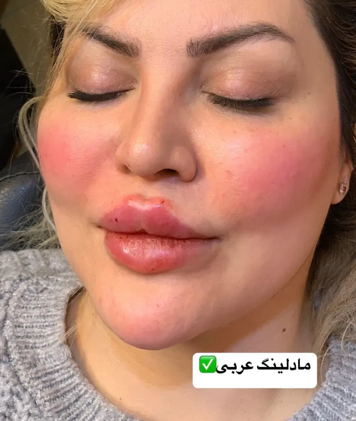 فیلر بادی ،تزریق ژل و بوتاکس با بهترین متریال قیمت|خدمات آرایشگری و زیبایی|دزفول, |دیوار