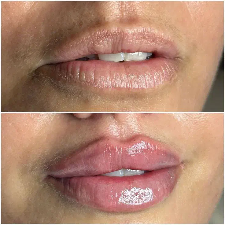 تزریق ژل و بوتاکس|خدمات آرایشگری و زیبایی|هشتگرد, شهرک ولیعصر (مصلی)|دیوار