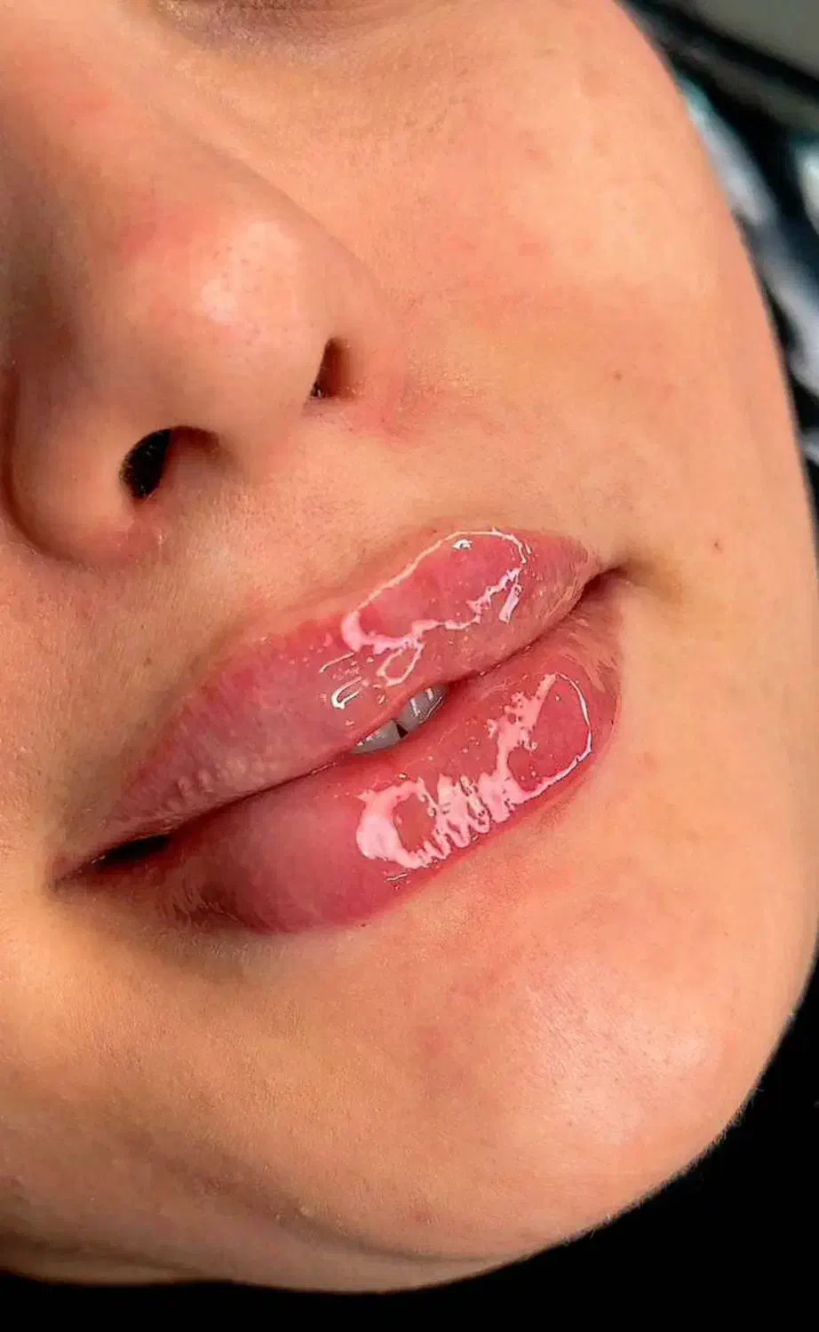 تزریق فیلر بادی بدن۱۲۰هزار|خدمات آرایشگری و زیبایی|جوانرود, |دیوار