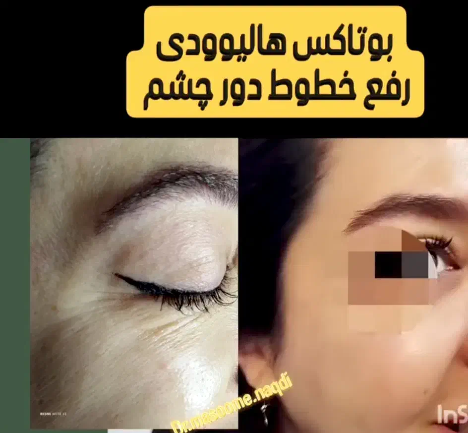 بوتاکس طبیعی درهرسنی|خدمات آرایشگری و زیبایی|رشت, بلوار گیلان|دیوار