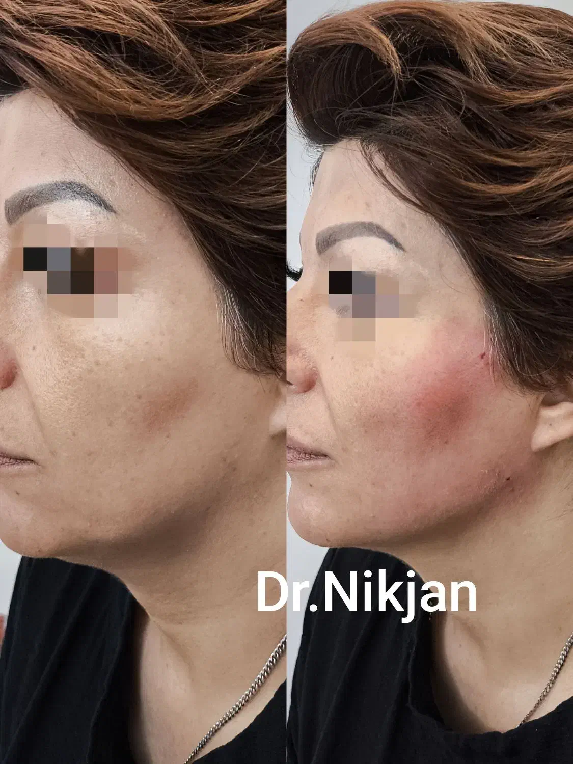 فیلر/بوتاکس/لب روسی/جوانساز/مزوژل مطب دکتر نیک جان|خدمات آرایشگری و زیبایی|رشت, گلسار|دیوار