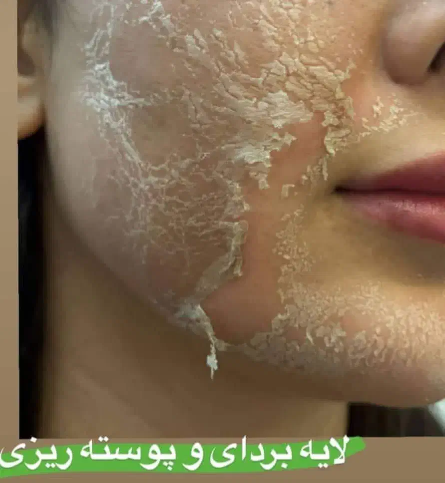 بوتاکس ژل مزوتراپی مو و صورت میکرونیدلینگ فشیال|خدمات آرایشگری و زیبایی|چهارباغ, |دیوار